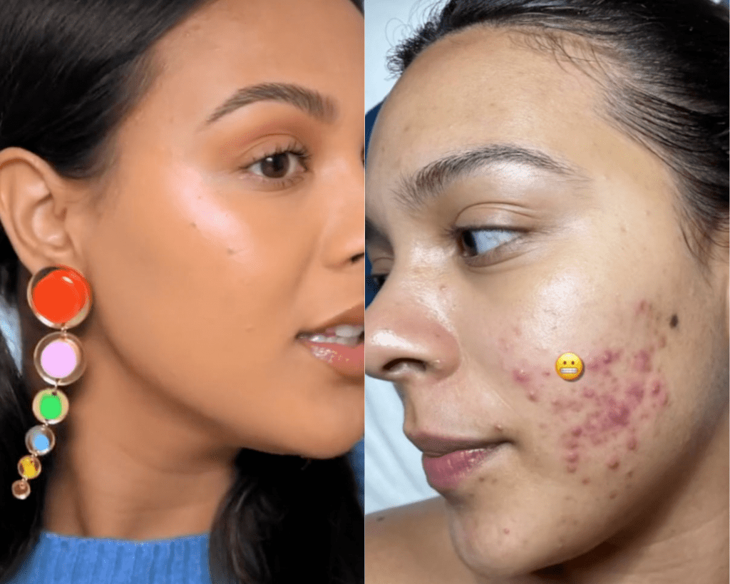 Shaving My Face Ruined My Life - Case 1: Natalie