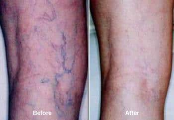 Top 7 Vein Therapy Procedures With Real Results 2025 Image 1 of Top 7 Vein Therapy Procedures With Real Results 2025
