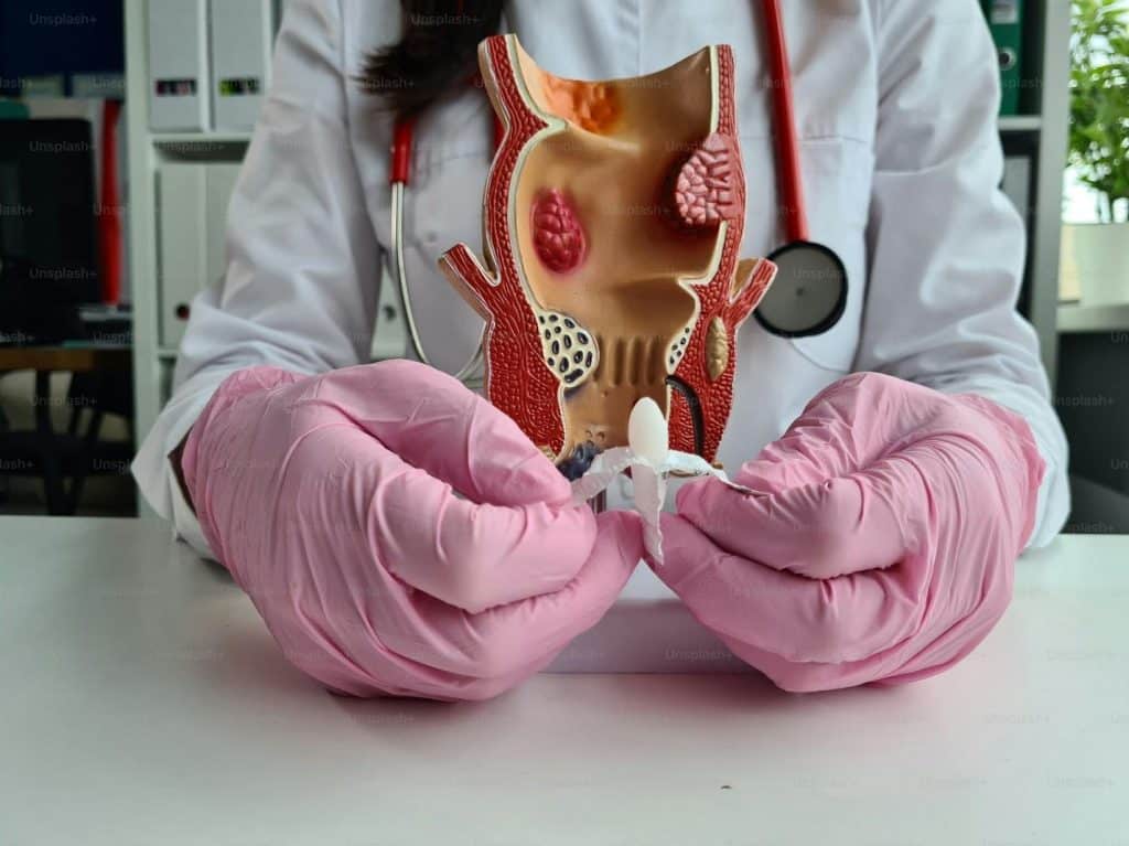 Image 1 of Explore the Different Stages of Hemorrhoids