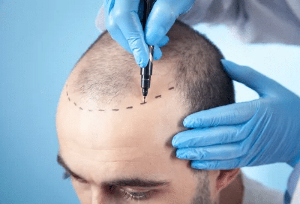 Ultimate Guide to Hair Loss Treatments for Men and Women: Prevention and Hair Transplant Options Image 1 of Ultimate Guide to Hair Loss Treatments for Men and Women: Prevention and Hair Transplant Options